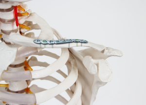 orthopedic locking plate