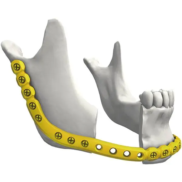 သော့ခတ်ခြင်း ပြန်လည်တည်ဆောက်ခြင်း ခန္ဓာဗေဒ 120° ပန်းကန် (အပေါက်တစ်ပေါက်တွင် ဝက်အူနှစ်မျိုးကို ရွေးချယ်ပါ)